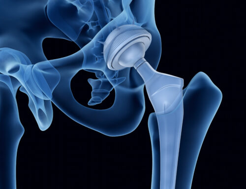 Home Exercises After Hip Replacement